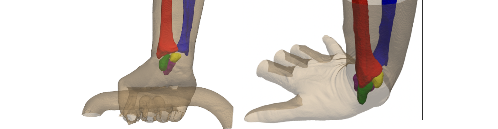 Assessing Carpal Alignment and Kinematics Using WBCT